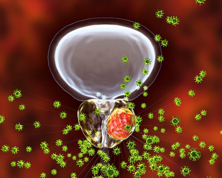 Prostate cancer tumor being attacked by viruses.