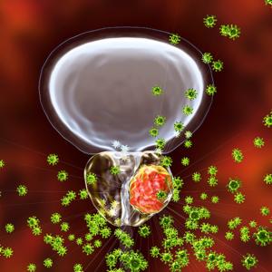 Prostate cancer tumor being attacked by viruses.